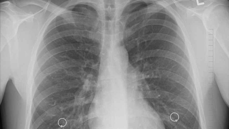 Ważną rolę w rozpoznaniu gruźlicy odgrywają zdjęcia klatki piersiowej i skórny odczyn tuberkulinowy. Fot. Pixabay.com